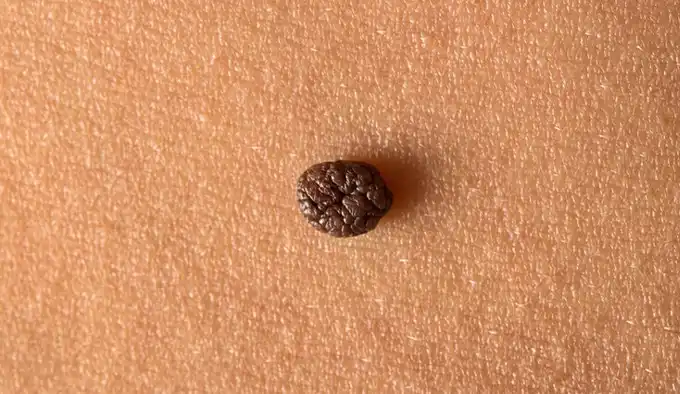 درﻣﺎن زﮔﯿﻞ ﺗﻨﺎﺳﻠﯽ ﺑﺎﻧﻮان (HPV) در شریعتی تهران | کلینیک سپیدا